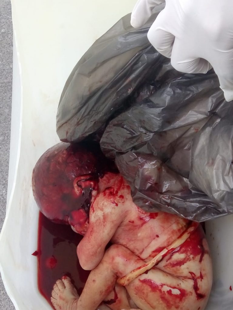 Recién nacido a la basura del hospital