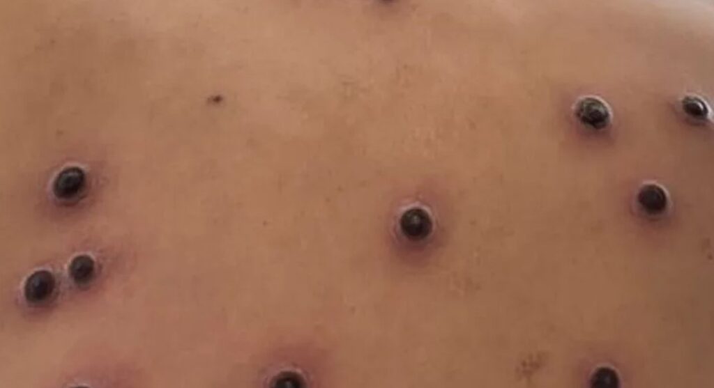 Medidas de prevención ante presencia de viruela símica