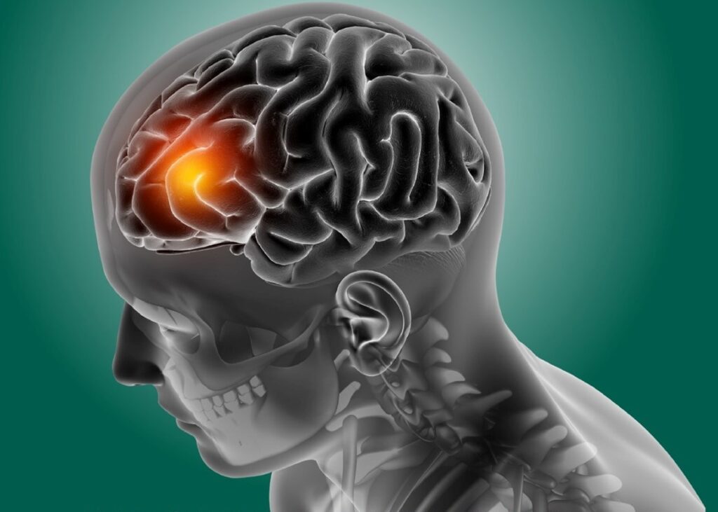 IMSS Hidalgo crea conciencia contra la meningitis