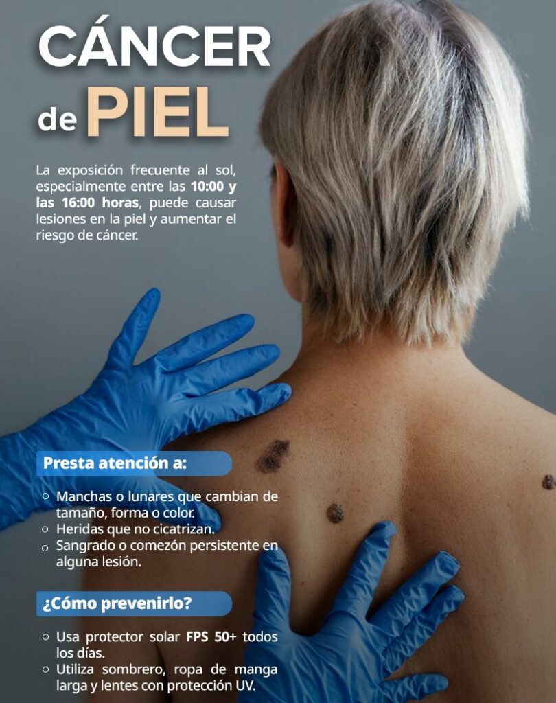 Usar bloqueador solar para evitar cáncer de piel